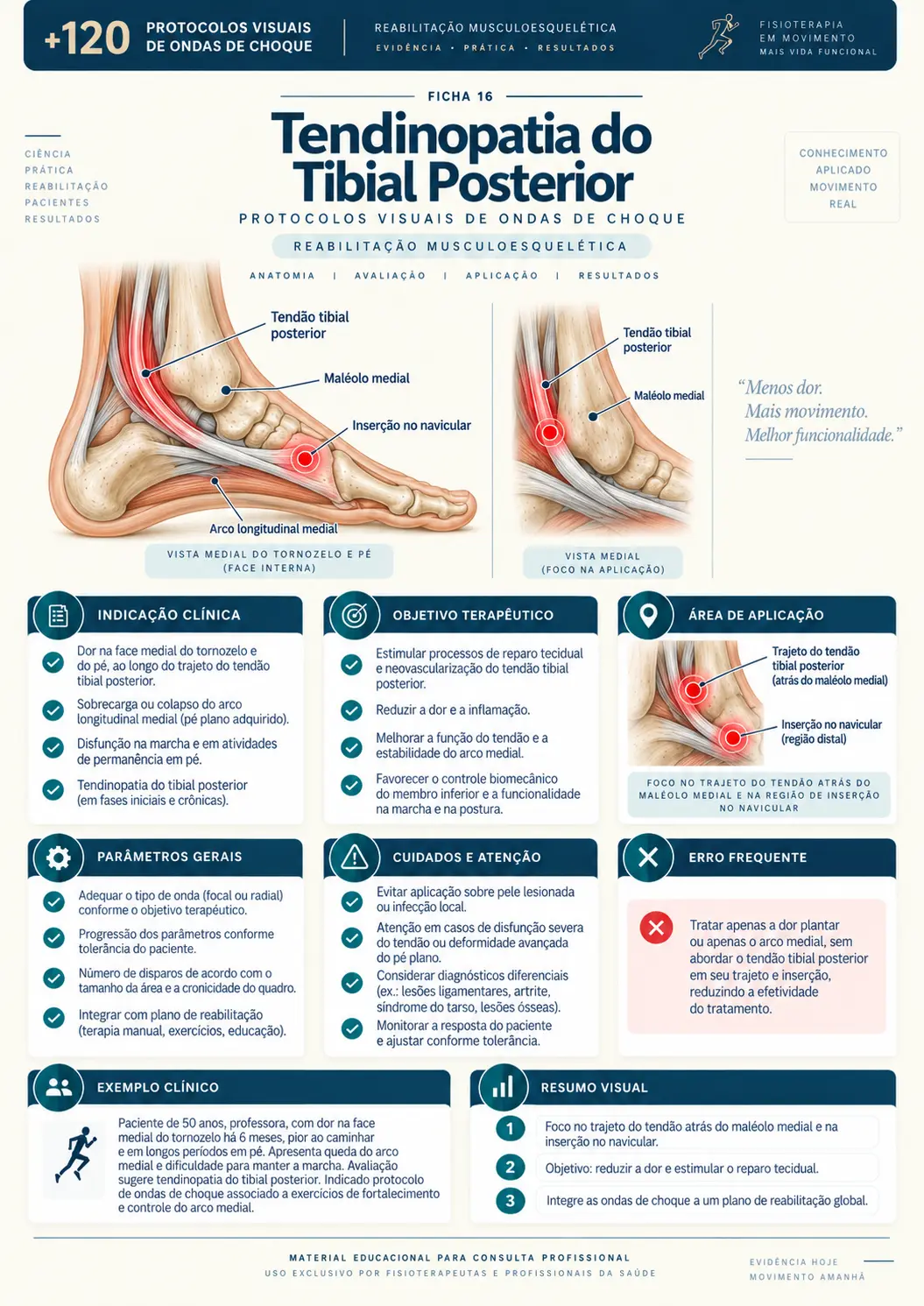 Tendinopatia do Tibial Posterior